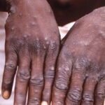 Um jovem mostra as mãos durante um surto de varíola dos macacos na República Democrática do Congo. Pele apresenta lesões provocadas pela doença.