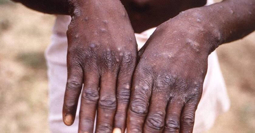Um jovem mostra as mãos durante um surto de varíola dos macacos na República Democrática do Congo. Pele apresenta lesões provocadas pela doença.