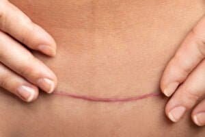 Cuidados para ter com seroma pós abdominoplastia