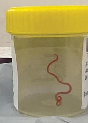 Mulher de 64 anos é diagnosticada com verme parasitário encontrado em pítons no cérebro