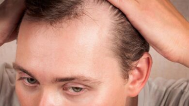 DHT: o hormônio da calvície